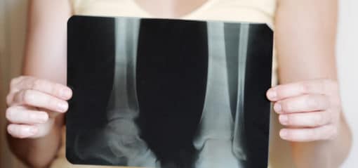 Benskörhet/Osteoporos